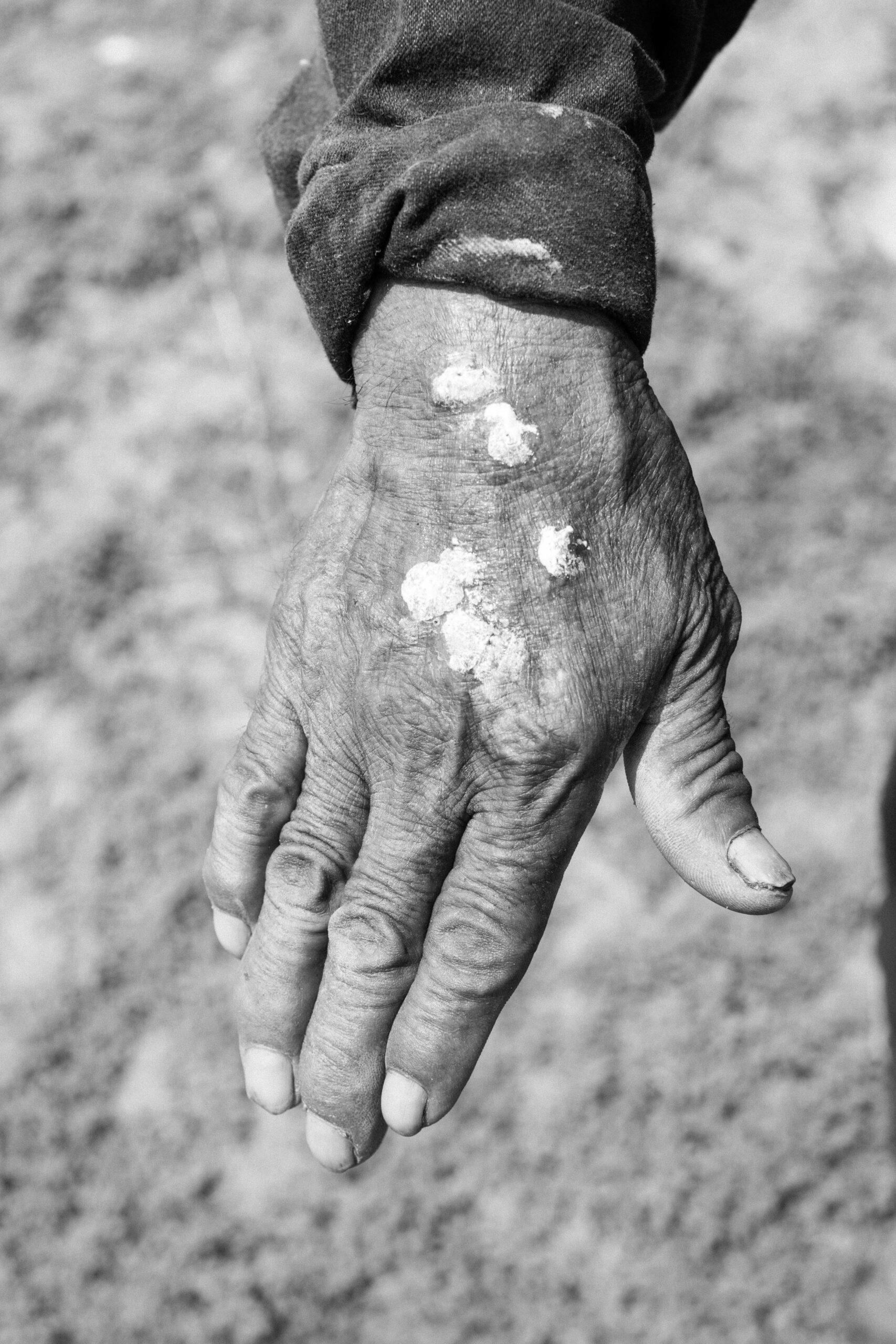 Jesús shows infected spots on his hands caused by water pollution at the completely dry Endhó Dam reservoir, May 12, 2024.